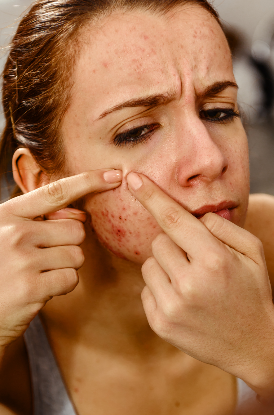 acnebehandeling enschede